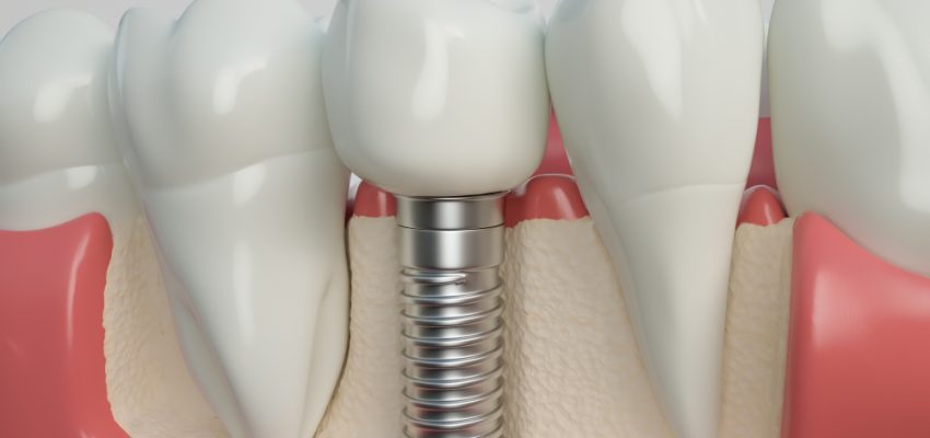 Un implant dentaire est utilisé pour remplacer une dent