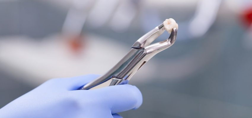 L'extraction dentaire d'une dent