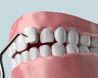 Une illustration 3D des facettes dentaires
